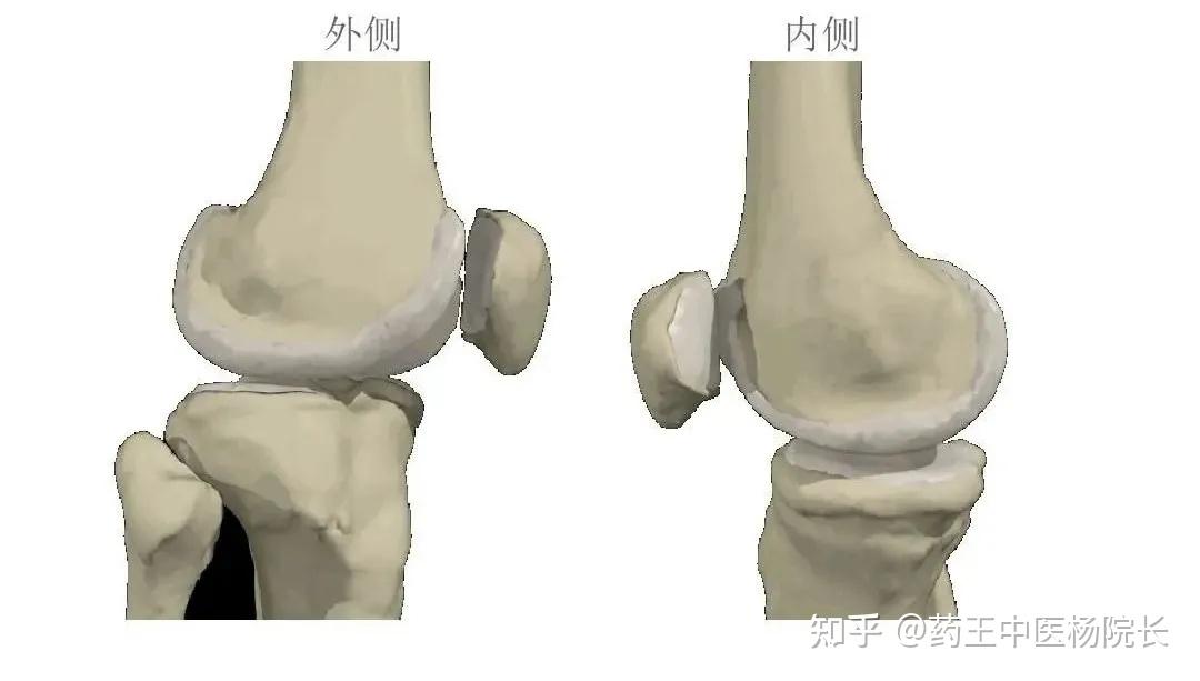 2,膝部外伤直接外伤可引起髌骨软骨骨折或因多次损伤引起软骨退变性