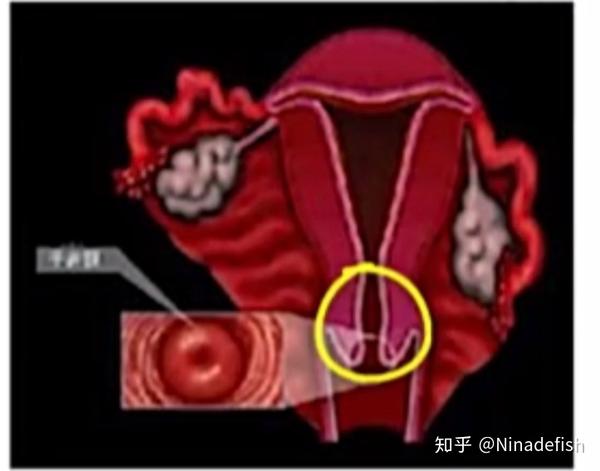 子宫颈含有腺体,可以分泌一种粘液,这个粘液可以随着月经周期的变化而