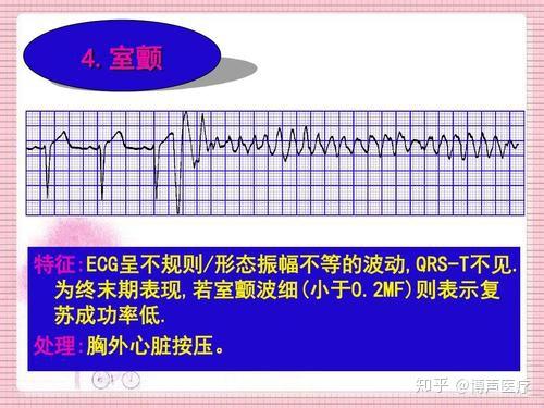 博声医疗室颤室颤心电图