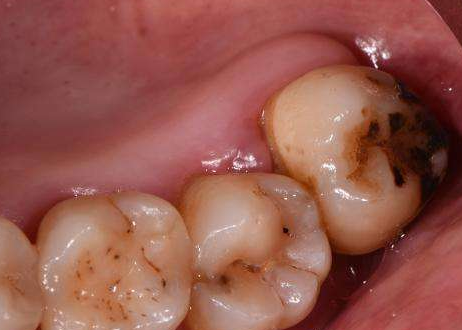 当智齿碰上牙髓炎,直接拔掉还是开髓后再拔掉?听听牙医的建议!
