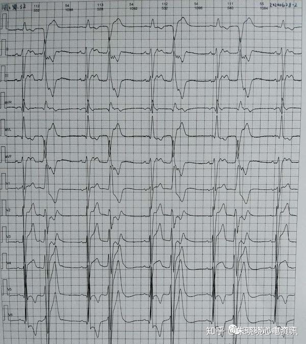 卢老师看心电图特殊类型的二联律67
