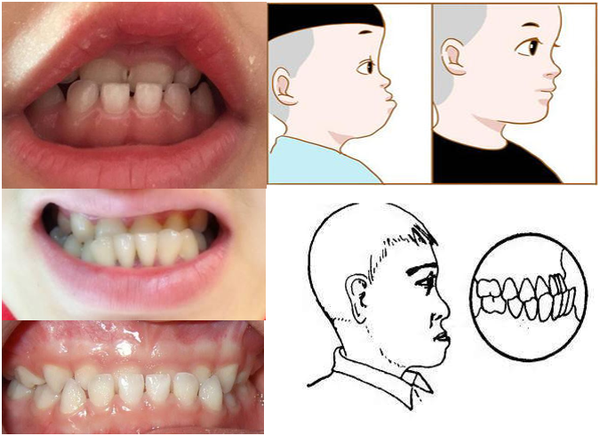 牙齿反颌比较特殊,反颌俗称地包天,这种情况医生都建议越早矫正
