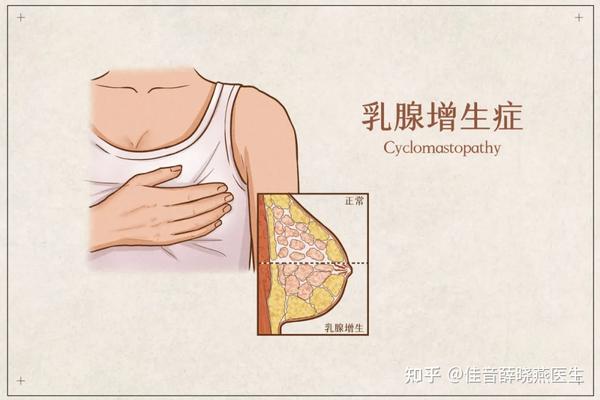 女性乳腺的"豹纹征"——囊性增生
