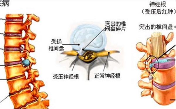 腰突朋友看过来为什么说马尾综合征是腰椎间盘突出最严重的并发症