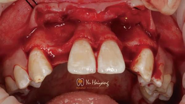 正畸牵引联合氧化锆基台修复双侧侧切牙缺失1例