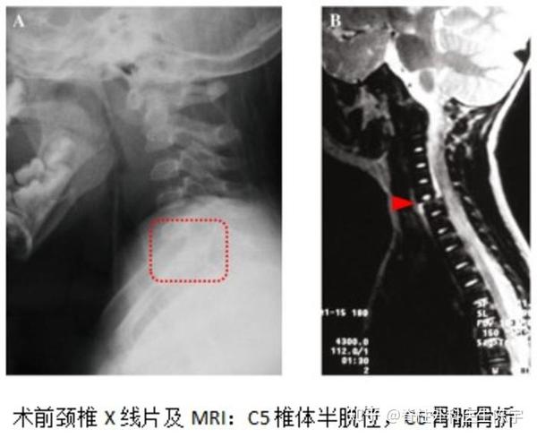 c5椎体再次出现半脱位,椎间关节出现绞锁;mri示,c6椎体上缘出现了骨骺