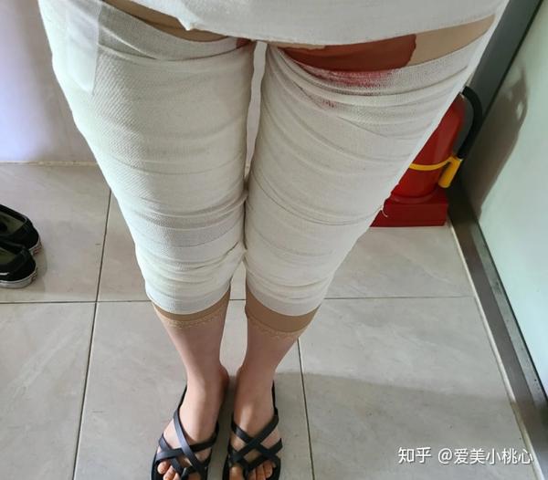 做了大腿吸脂的我,摆脱了困扰我25年的大肥腿!