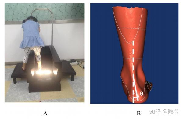 (a) 一名cp外翻儿童接受足部3d激光扫描;(b):负重位时跟骨外翻角