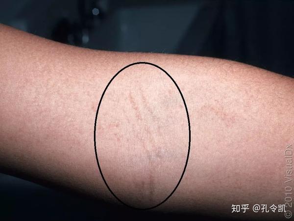 褪色,这种密集的皮疹经常呈线状排列,称为帕氏线(是个姓帕的人命名的)