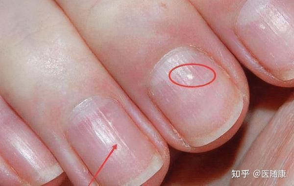 指甲上有很多竖纹是怎么回事和肝癌有联系吗