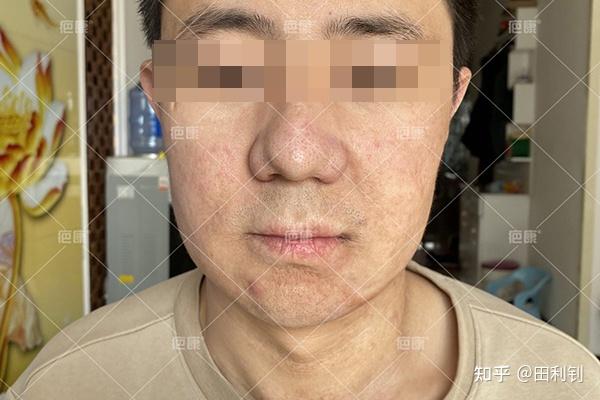 【治疗案例】山西闰先生面部2年烧伤疤痕增生