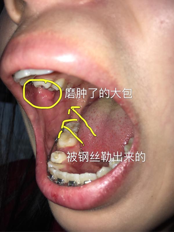 25 岁后去矫正牙齿(带牙套)是什么体验?