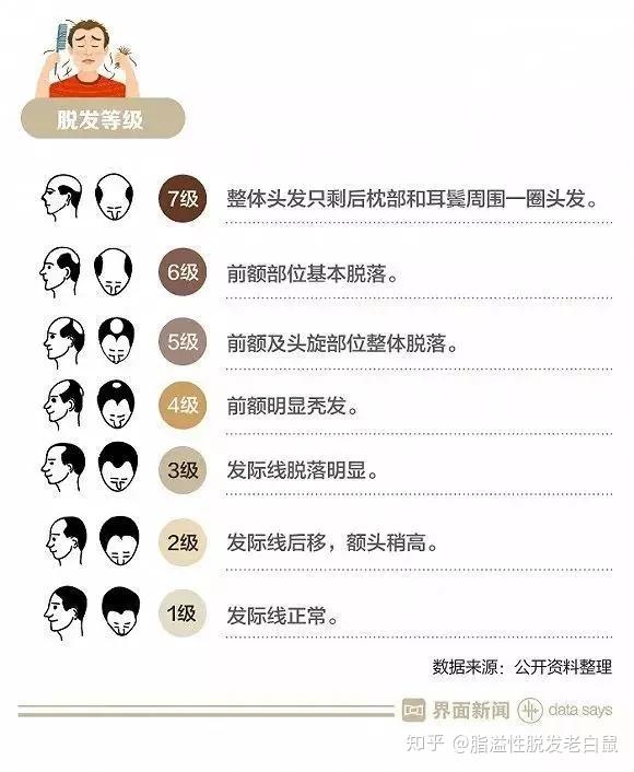 自我判断脱发等级程度(我是五级)