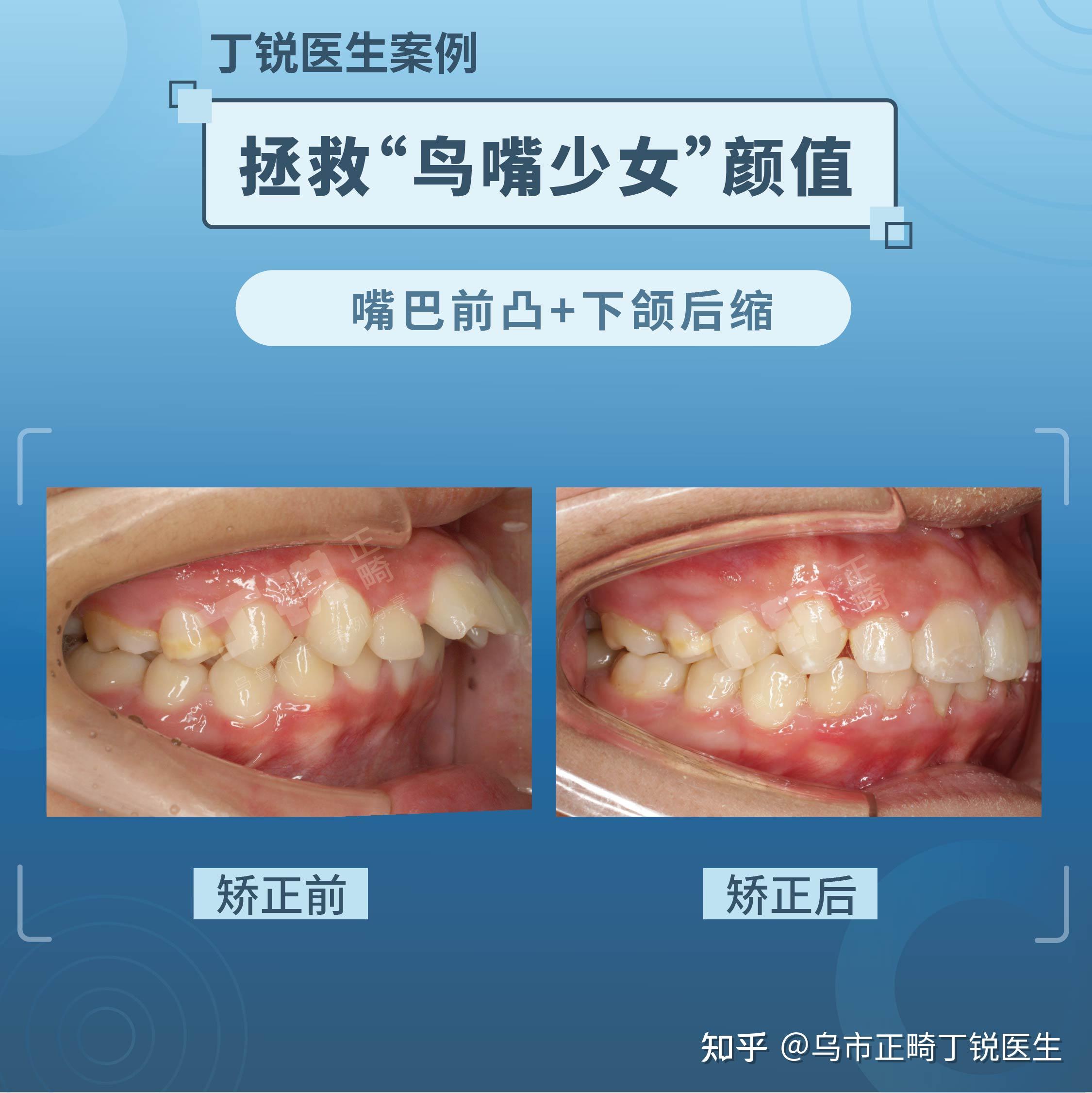 乌市牙齿矫正拯救鸟嘴少女颜值