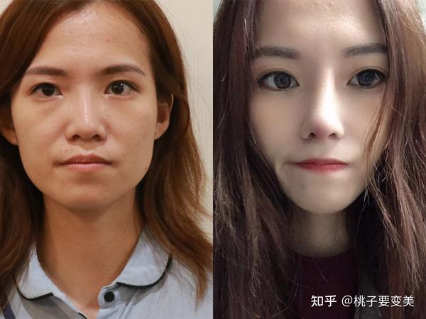 背线条流畅,能做骨感驼峰,鼻头圆润立体,对一般的鼻翼宽大能自然改小