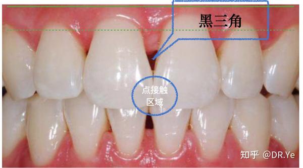 黑三角怎么来的