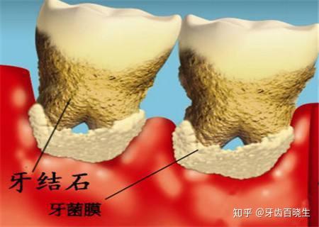 为什么牙齿上会长结石?