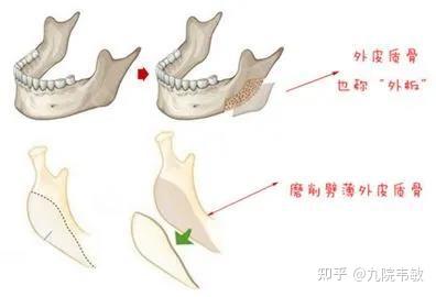 九院韦敏说,下颌骨截骨与劈外板有什么区别?