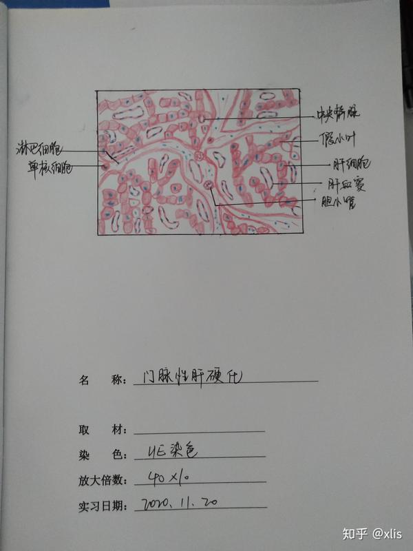 门脉性肝硬化 红蓝铅笔手绘