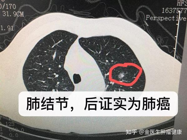 核心提示肺部结节是由于一些疾病导致的比如说肺结核或者是一些肿瘤