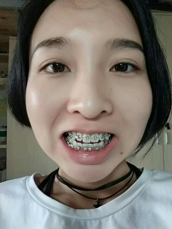 附上大牙套照一张