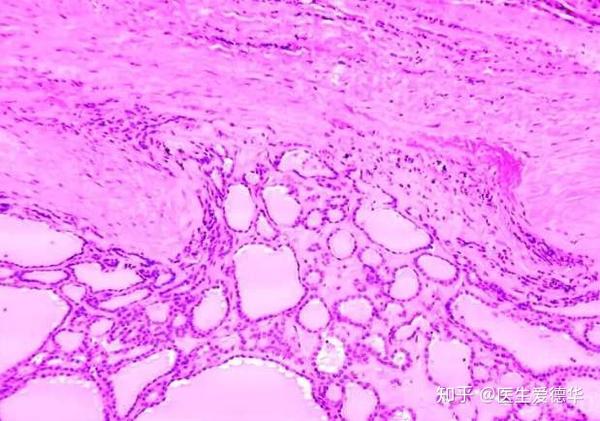 甲状腺滤泡癌,可以看到一个个由癌细胞组成的假滤泡.