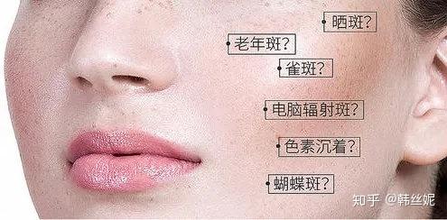 斑的种类有很多,不同的斑形成的原因也不一样: 雀斑是与遗传相关的