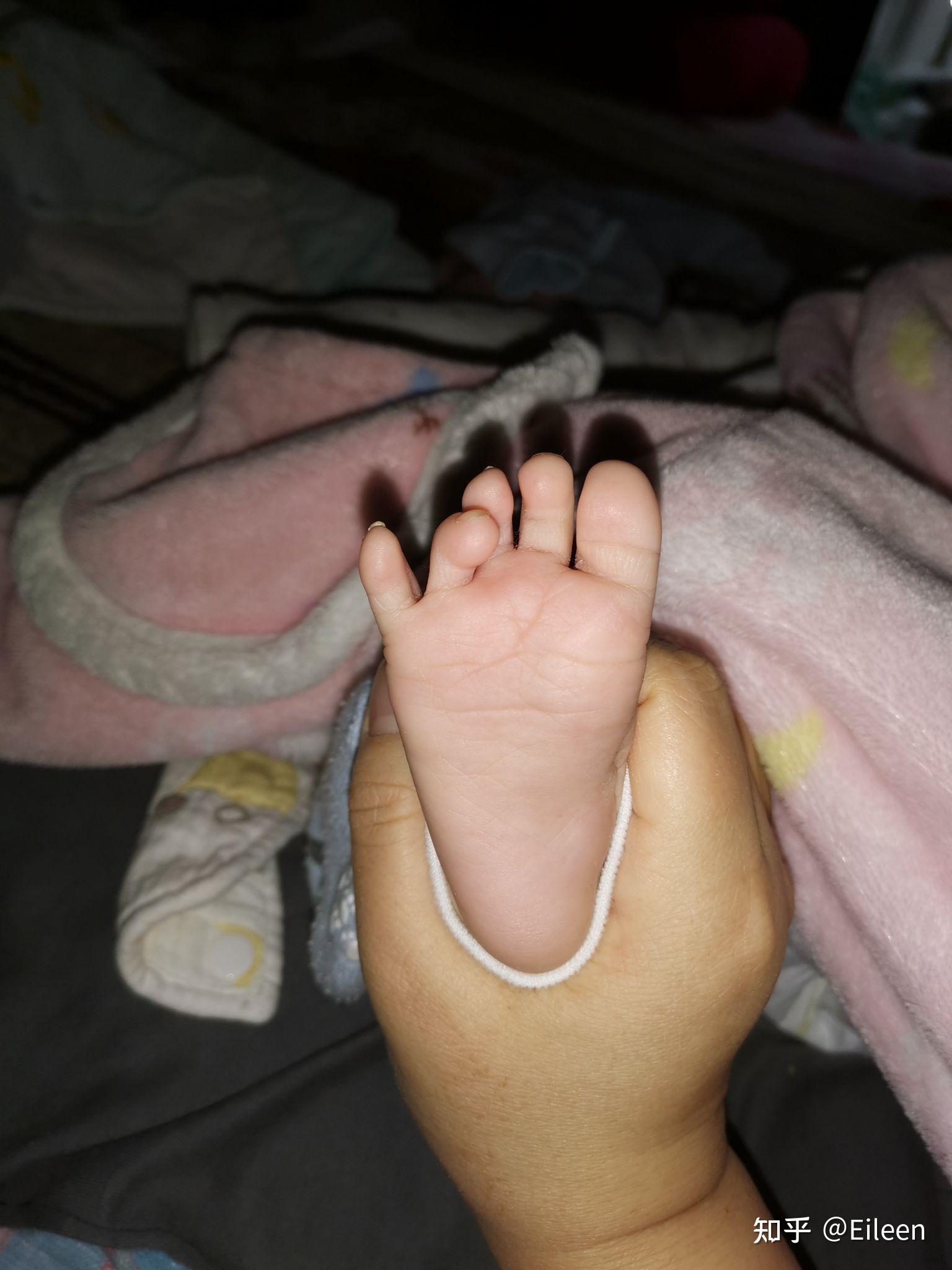 5月大婴儿脚趾重叠如何矫正