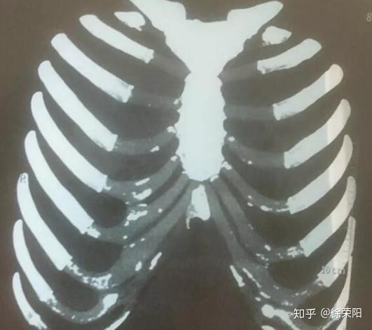 肋软骨钙化了怎么回事钙化的肋软骨还能做鼻综合整形吗