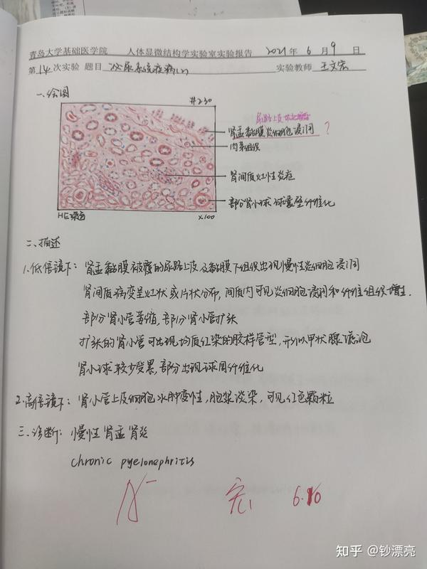 15.急性粟粒性肺结核