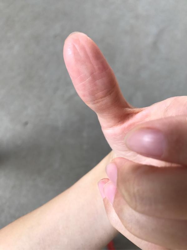生产后手指尖干瘪长竖纹怎么回事?有办法治疗吗?