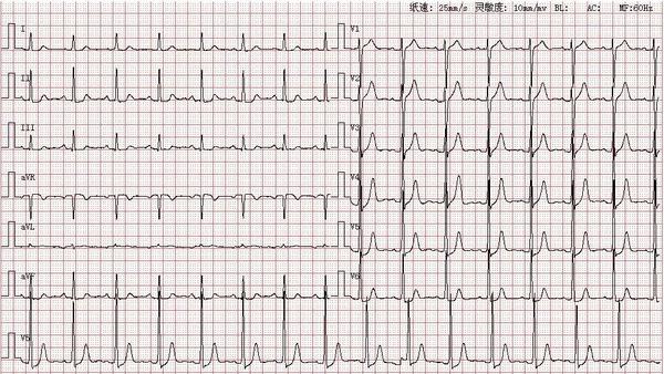 如图可见患者p波在Ⅰ,Ⅱ,avf,v4-v6导联直立向上,avr导联向下,由此