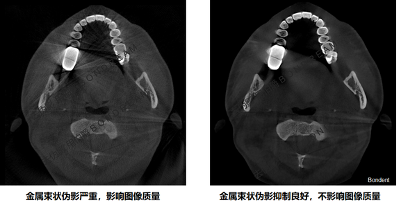 cbct影像的 金属伪影对比(病例2)