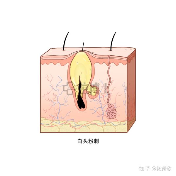 毛囊扩张明显,内部角质团块致密,毛囊皮脂腺导管处形成皮脂栓,加重了