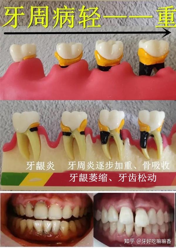 牙周炎导致牙齿脱落的原因