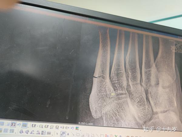 第五跖骨骨折快两个月了都没好