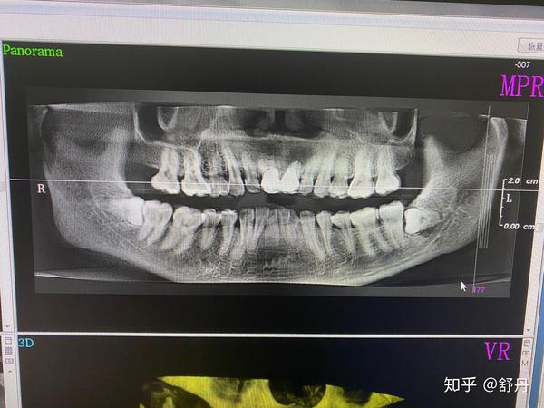 上颚骨口腔囊肿,我的门牙改怎么处置啊?求意见.