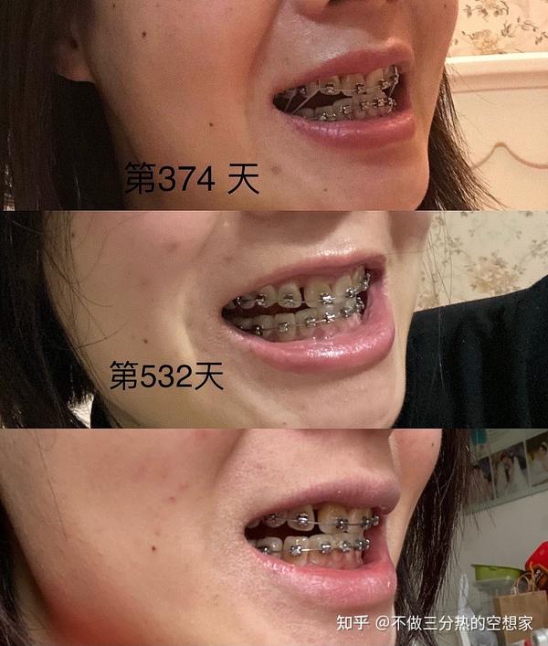 2019年28岁自锁钢牙矫正全过程(闭锁型深覆合深覆盖)