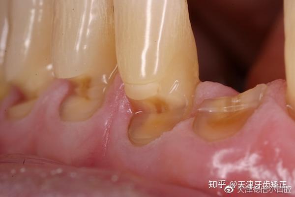 横向拉锯式刷牙对导致牙颈部出现楔状缺损,暴露牙本质,引发牙齿敏感