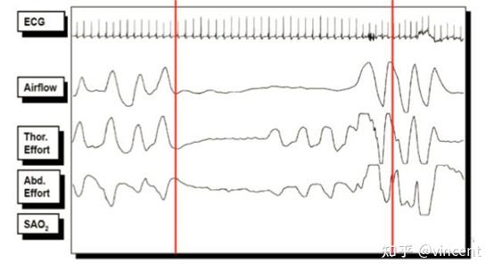 多导联睡眠呼吸监测psg解读