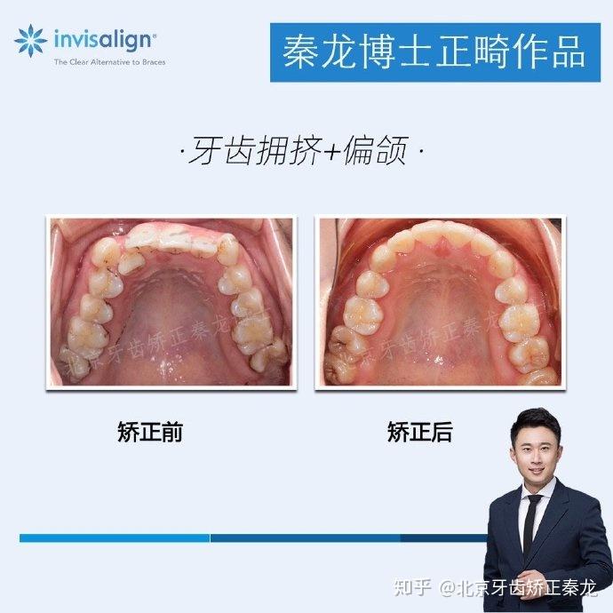 北京秦龙医生牙齿拥挤严重偏颌案例分享