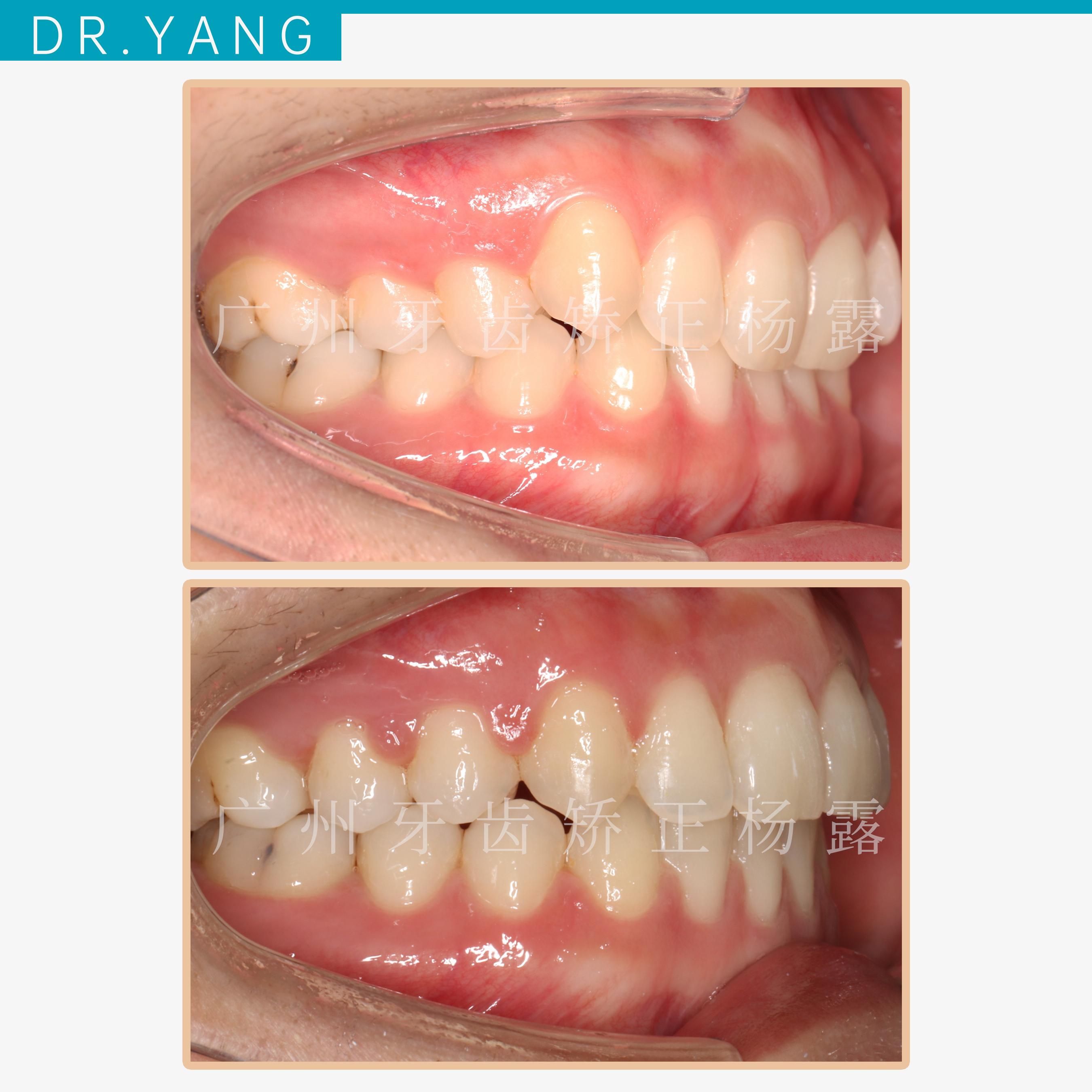 佳木斯大学 口腔医学硕士广州牙齿矫正杨露