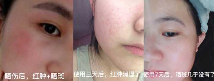 用了大概一个星期之后,脸上的晒斑也慢慢不见了,被晒起皮的地方也在