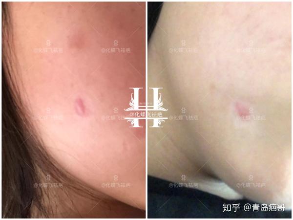 经朋友介绍开始使用中药进行疤痕修复,坚持涂药,代谢四次,增生凸起平