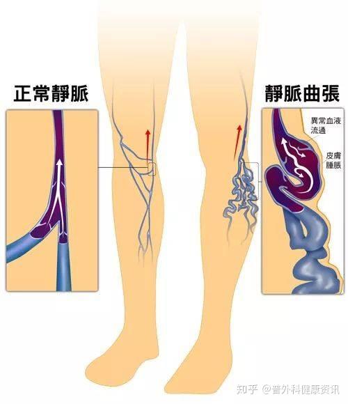 试试深静脉回流通畅