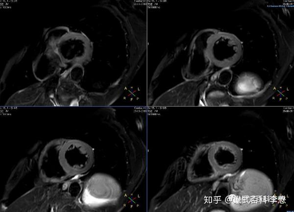 心脏磁共振技术大全(二)