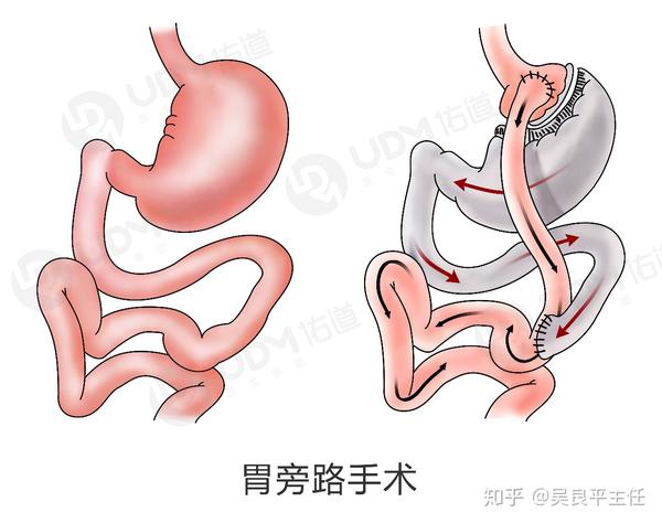 胃转流术采用外科手段,通过胃肠吻合,肠肠吻合等步骤改变食物的生理