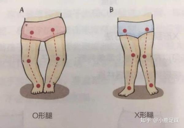 宝宝长成o型腿,可能是因为妈妈做错了这3件事造成的!