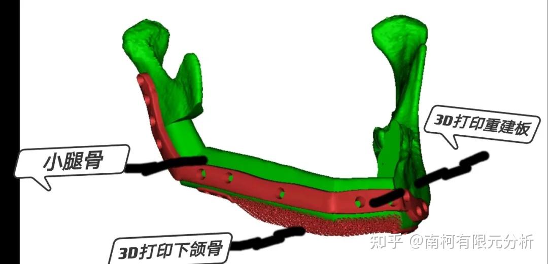 山东大学第二医院妙手易容3d打印骨和小腿骨组装变下巴