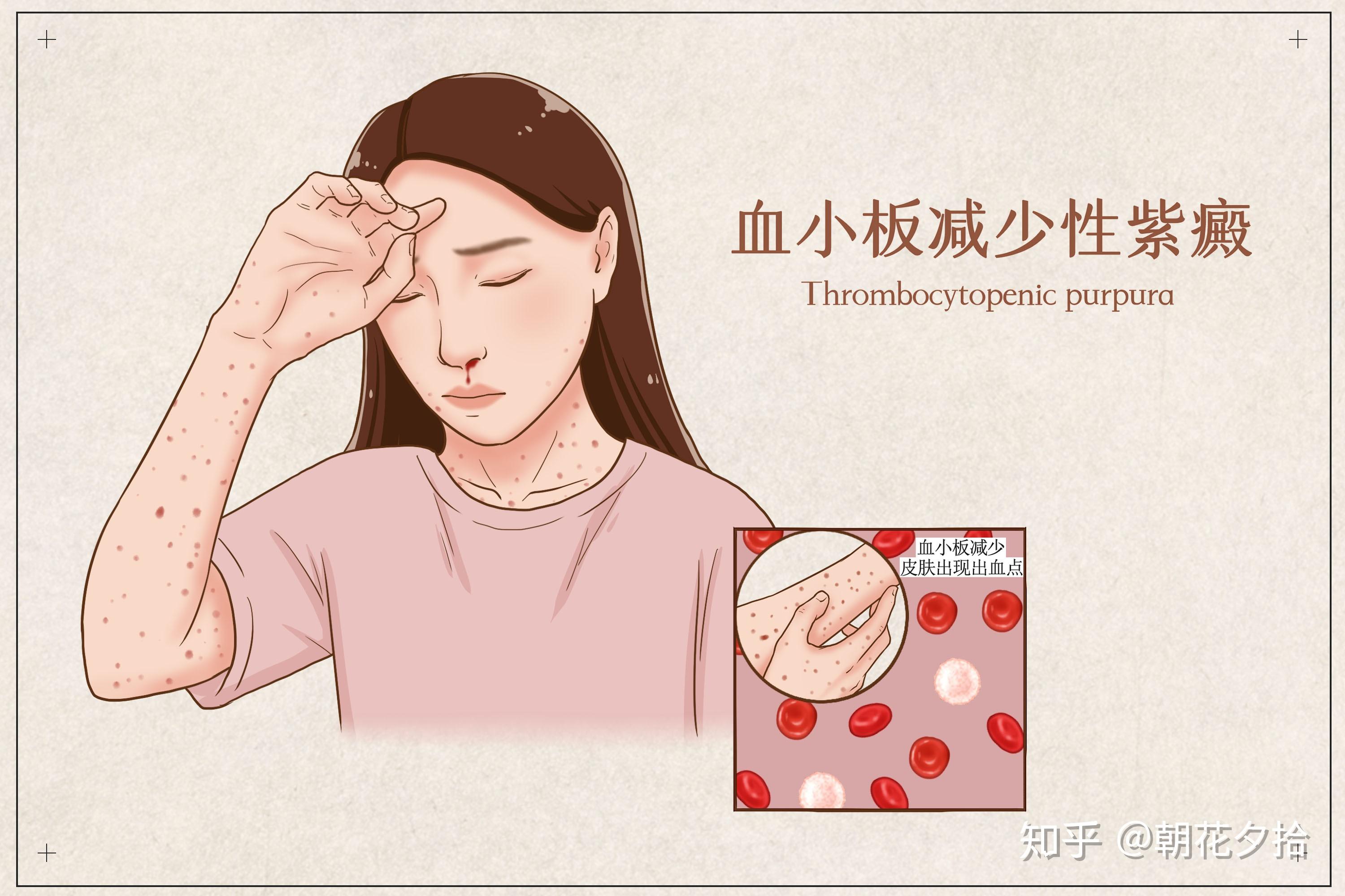 血小板减少到多少会有出血症状
